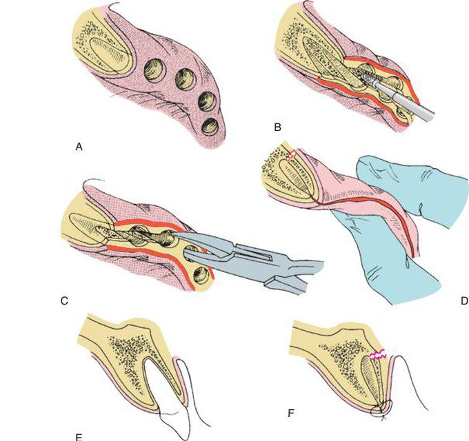 Intraseptal alveoloplasty