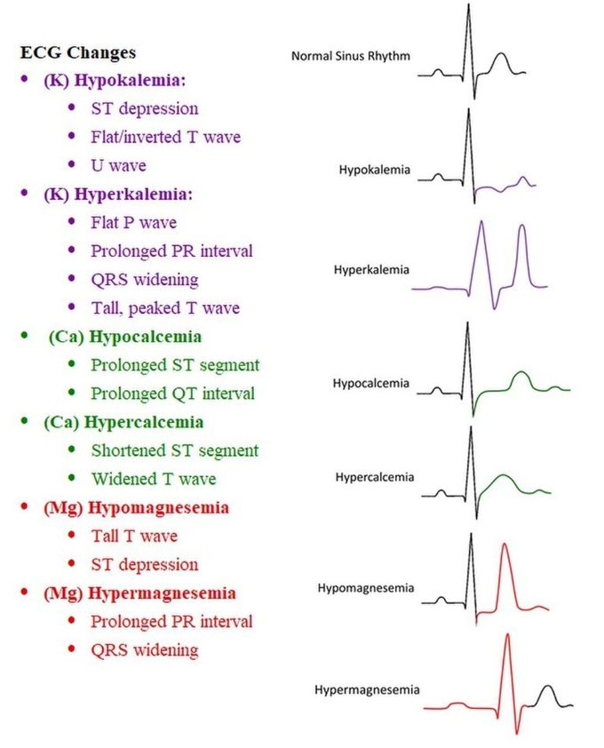 ECG Changes