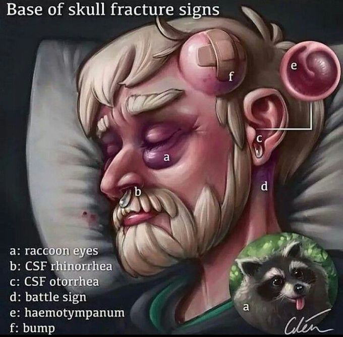 Base of Skull Fractures