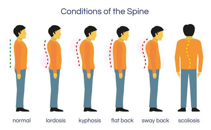 Kyphosis causes