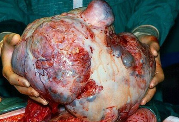 Mega large ovarian mucinous cystadenoma!