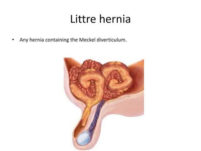 Littre hernia