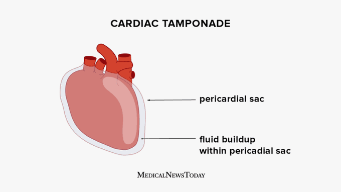 What causes cardiac temponade?
