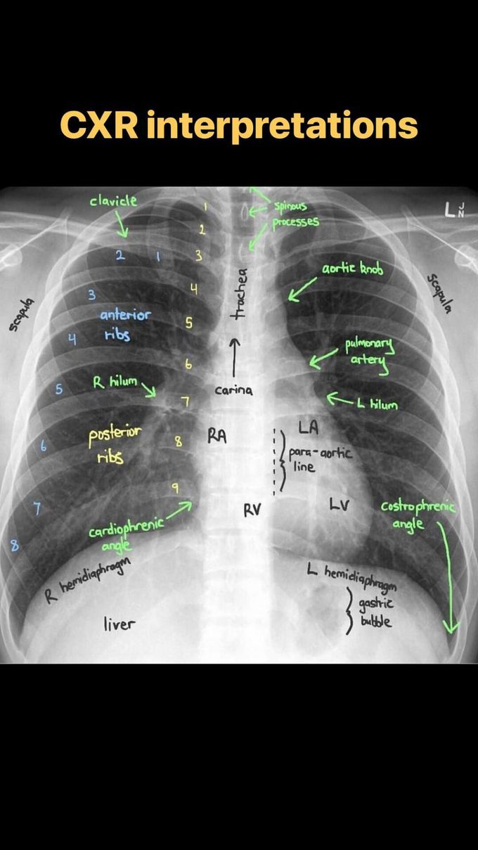 Cxr Interpretation Medizzy