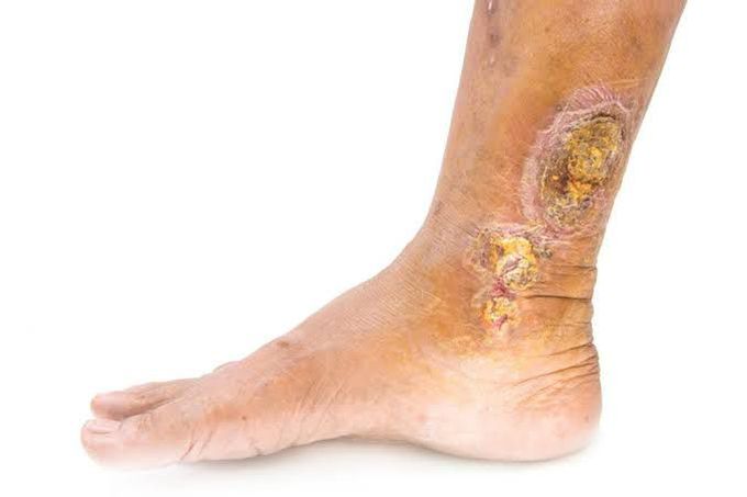 Venous Ulcers