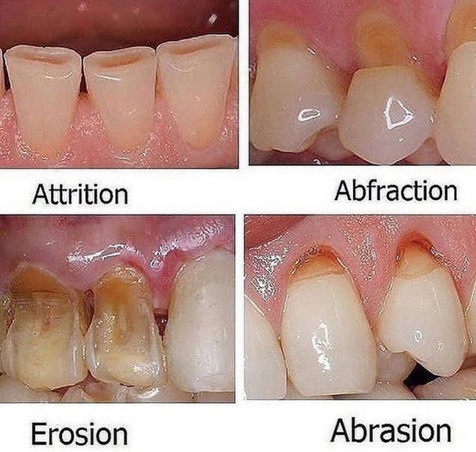 Types of Tooth Wear