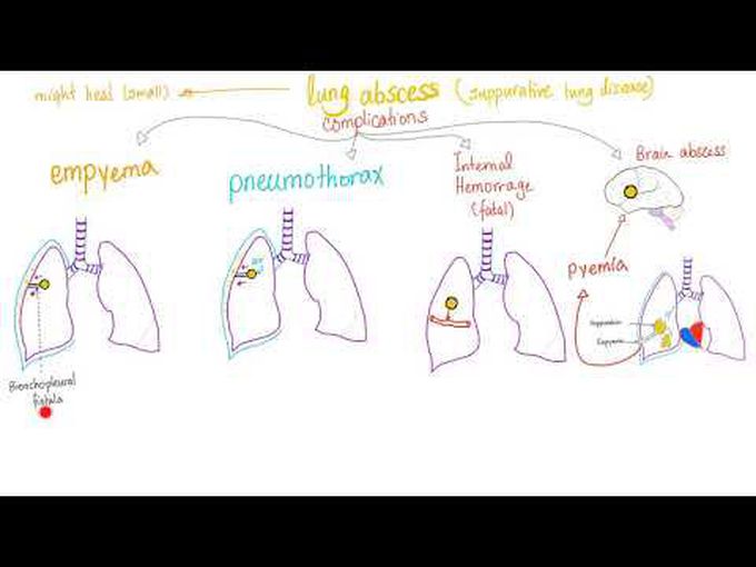 Review of Lung Abscess and Aspiration Syndrome