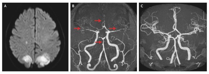 Reversible Cerebral Vasoconstriction after Preeclampsia