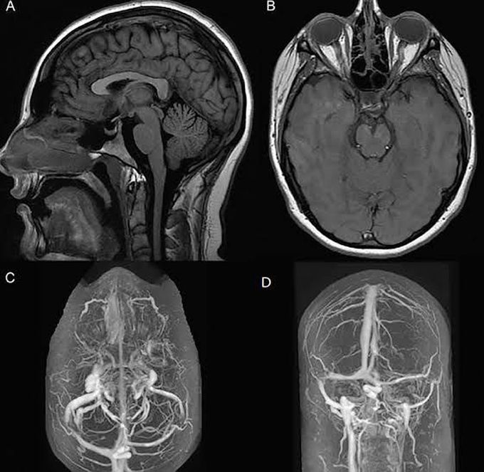 Idiopathic intracranial hypertension