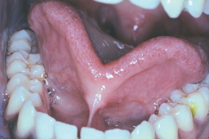 Ankyloglossia