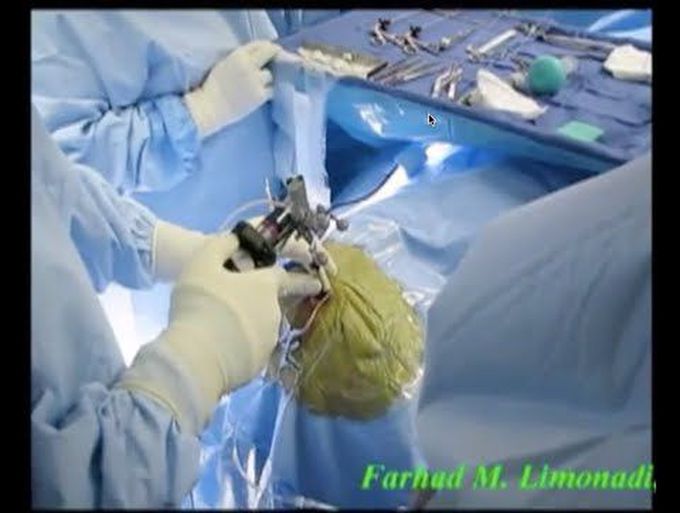 Video of Minimally Invasive Brain Surgery: resection of a complex brain tumor (Craniopharyngioma)