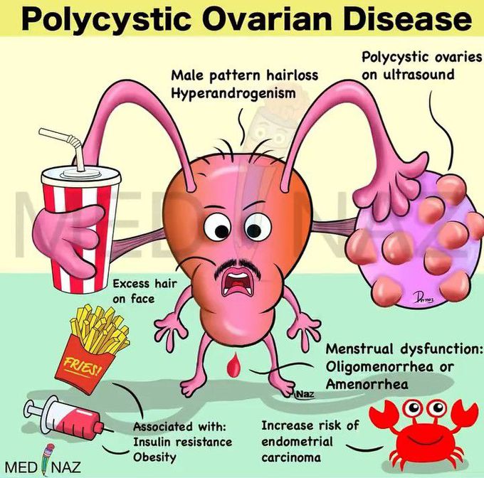 Polycystic Ovarian Disease