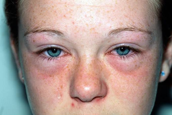 Symptoms of hay fever