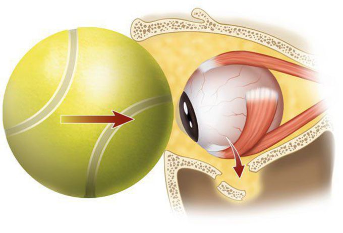 Mechanism of Blow-out fracture in the roof of orbit.