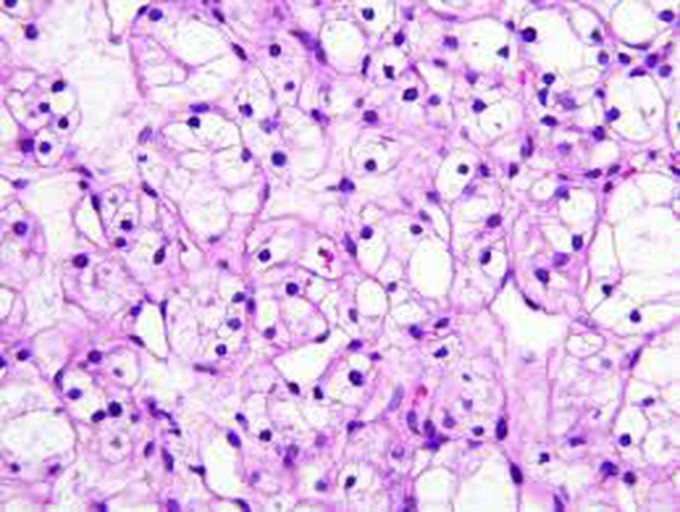 Clear cell carcinoma