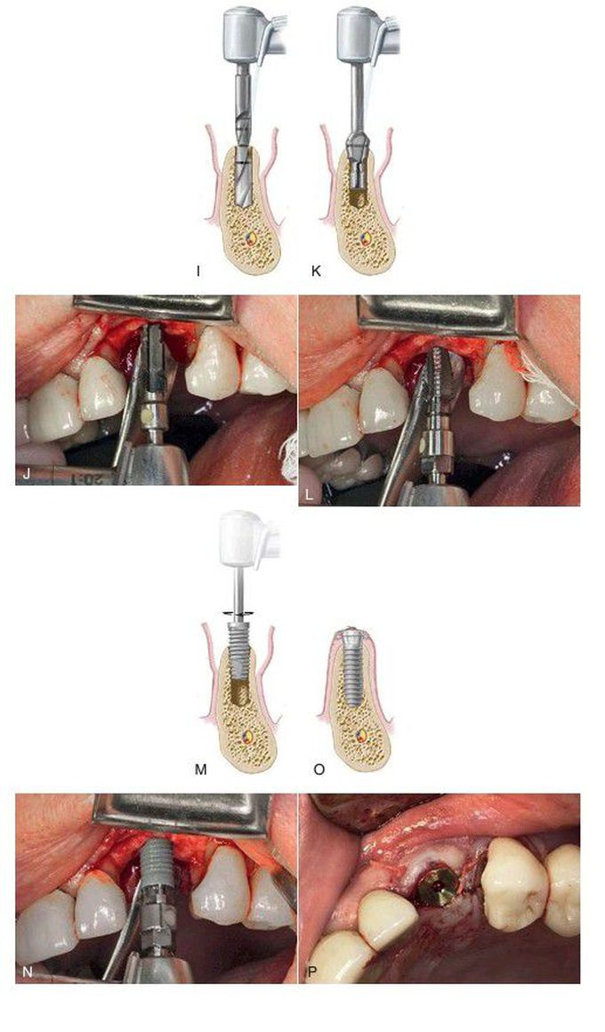 Implant placement