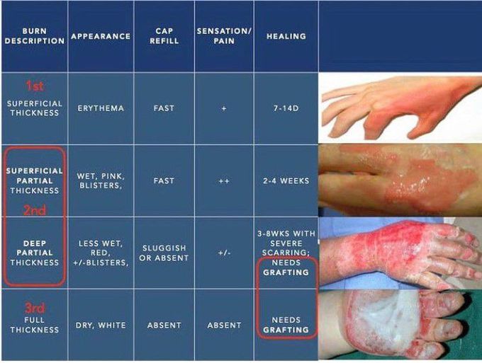 The three levels of burns.