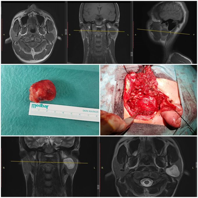 Pleomorphic adenoma