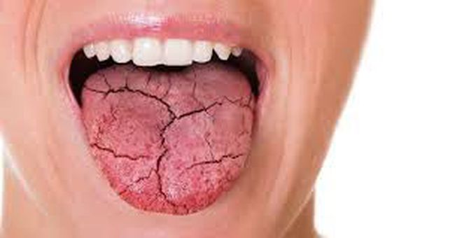 What causes dry mouth?