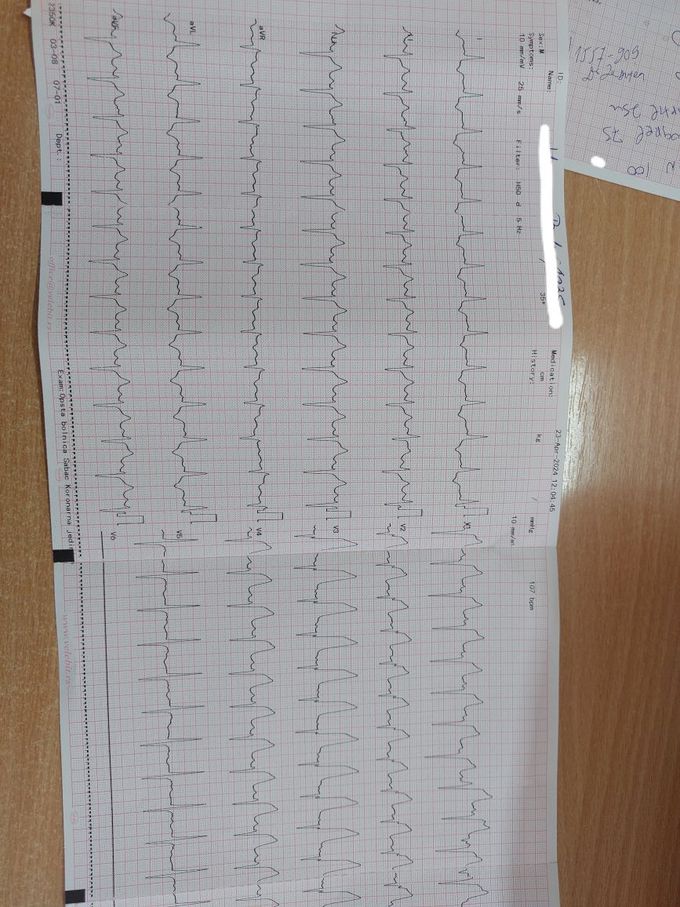 Ekg -STEMI