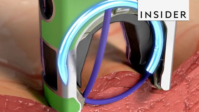 Really cool invention: Device Creates Precise Surgical Sutures! 😍