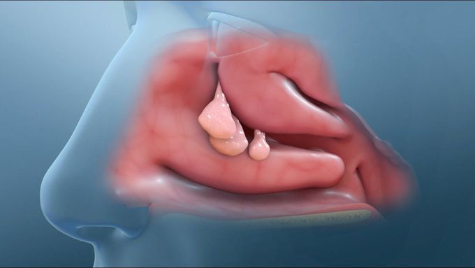 Nasal Polyp Removal Surgery