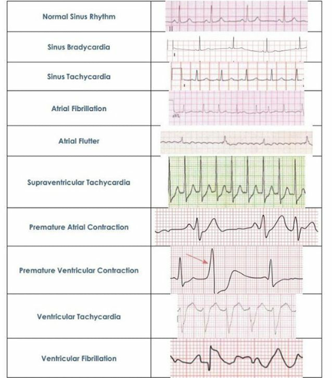 ECG interpretation