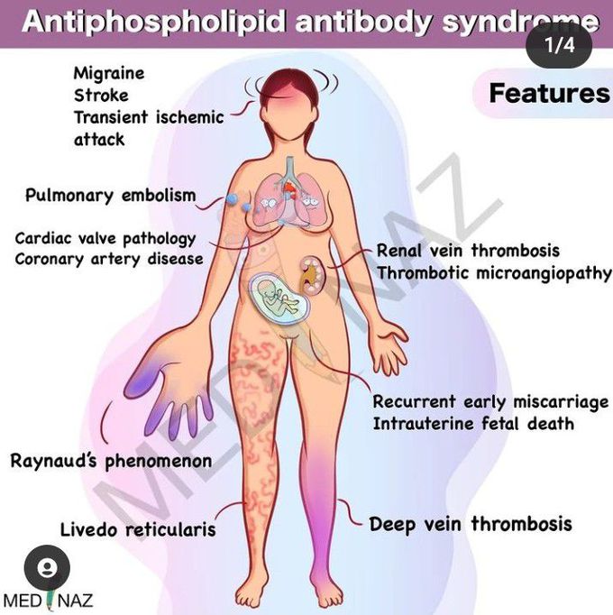 Antiphospholipid antibody syndrome