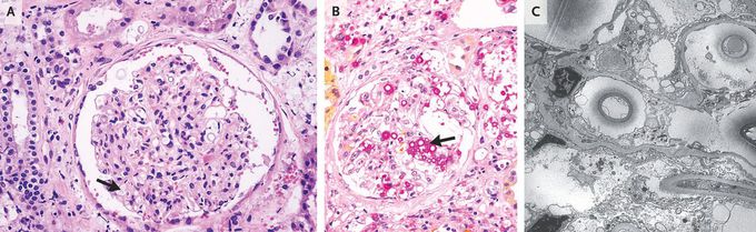 Renal Cryptococcosis