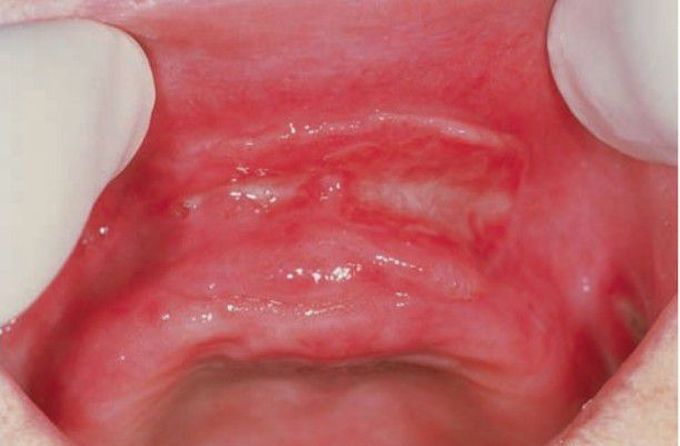Denture induced fibrous hyperplasia