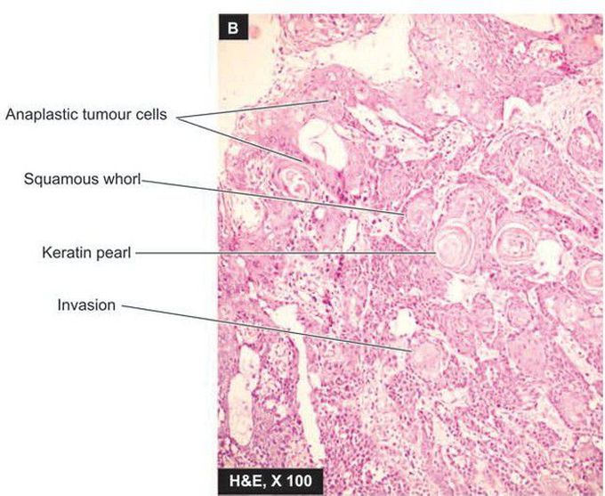 Squamous cell carcinoma of oesophagus