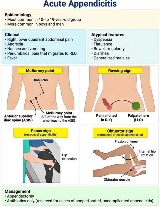 Acute Appendicitis