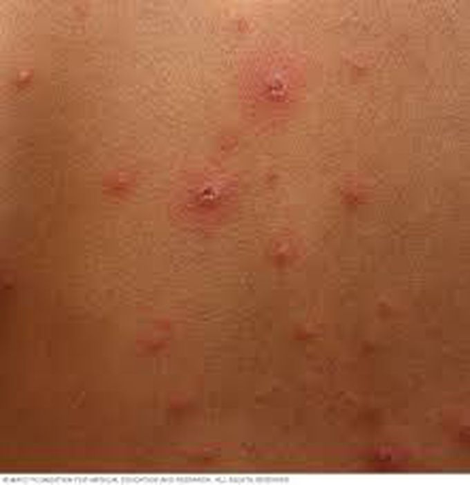 Chicken pox
