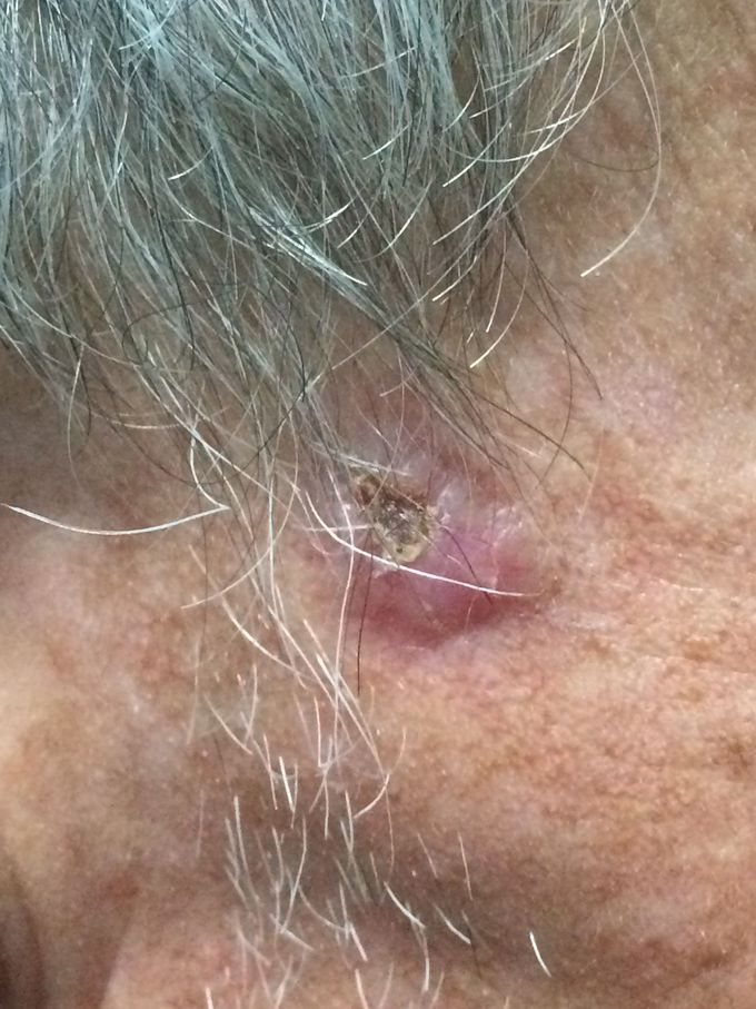 Skin lesion