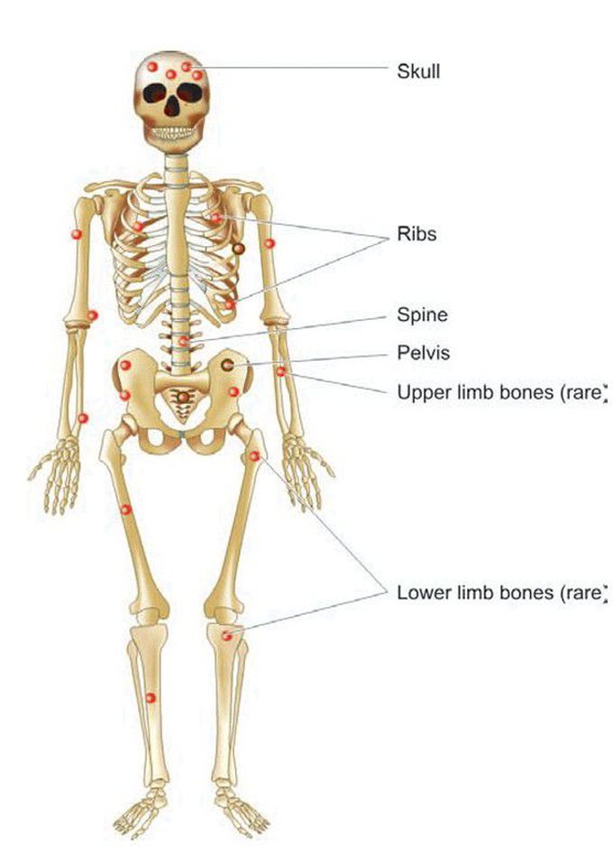 Multiple myeloma.