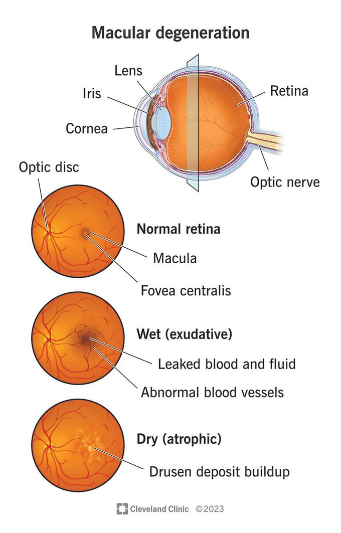 What are the symptoms of macular degeneration?