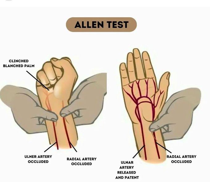 Allen Test