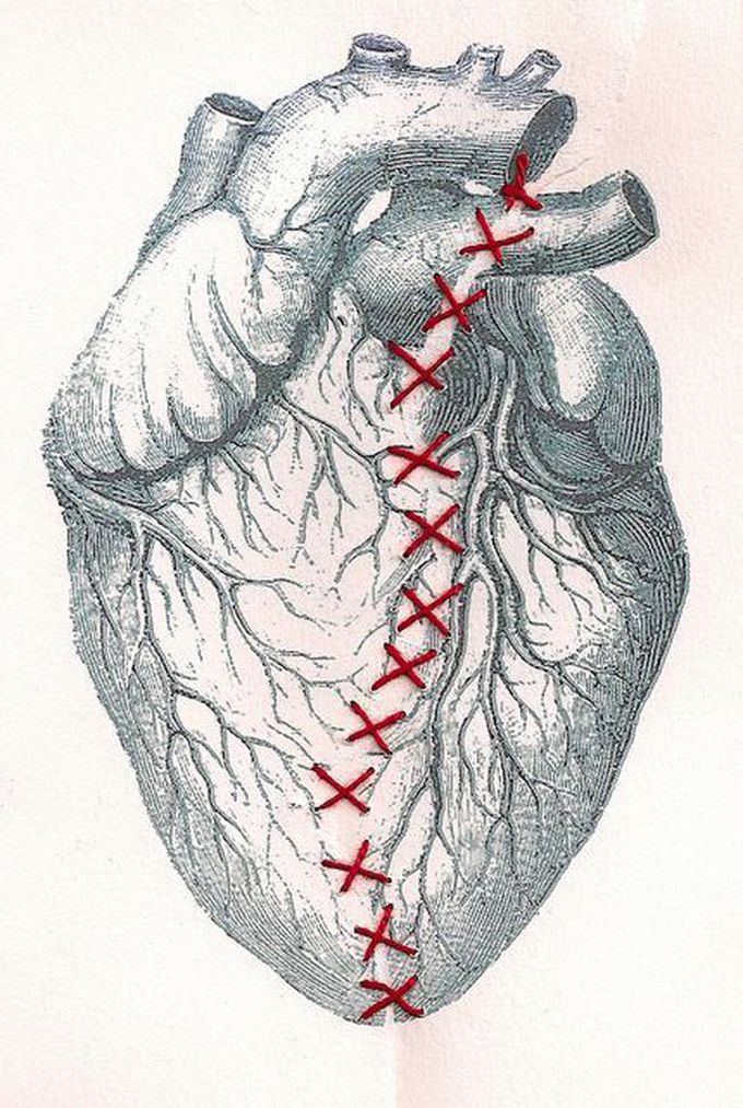 Heart “surgery”