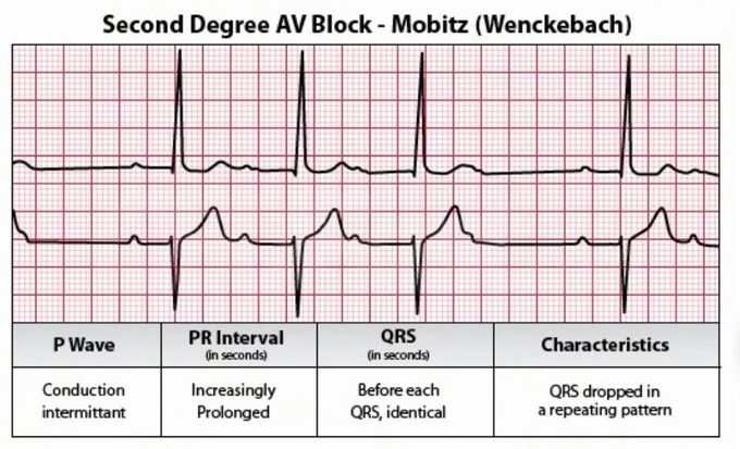 heart block 2nd Degree