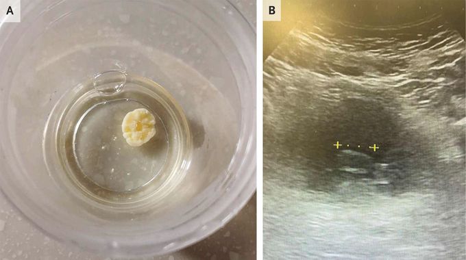 Fungal Ball in the Urinary Bladder