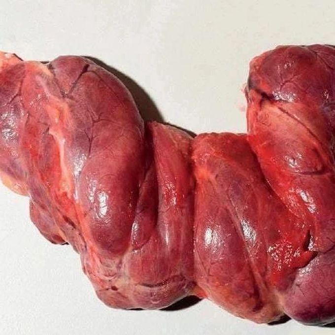 Enlarged Thyroid Gland
