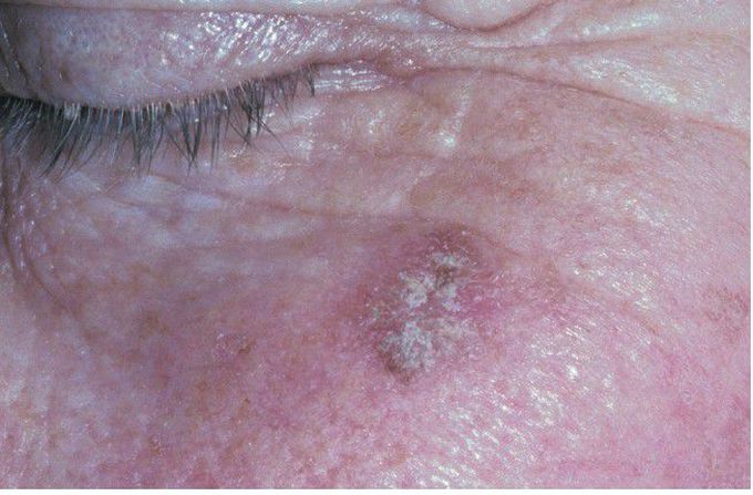 Actinic Keratosis