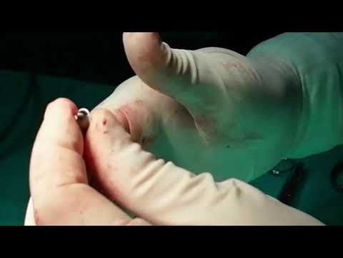 Direct Beating Heart NeoChord Mitral Valve Re-Repair