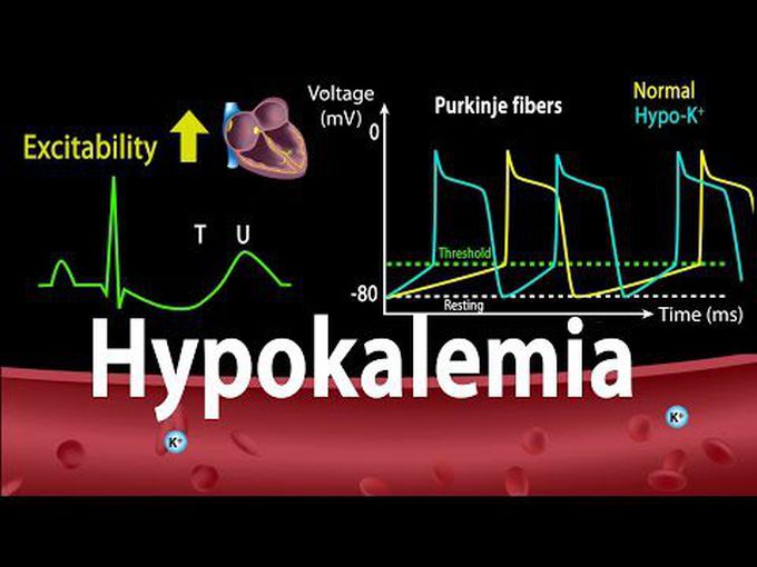 Hypokalemia and its effect on the heart