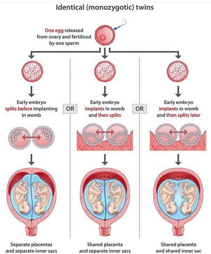 Types of Monozygotic Twins