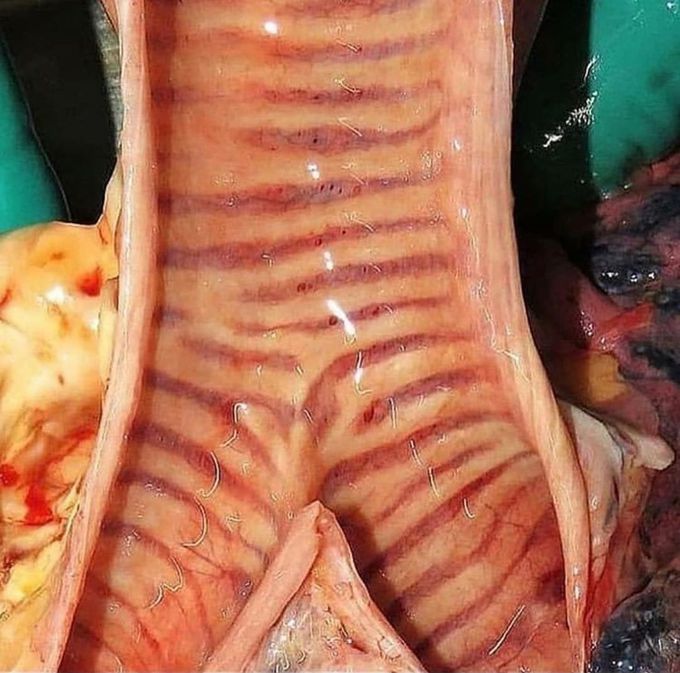 A great view of the inside of your trachea. 