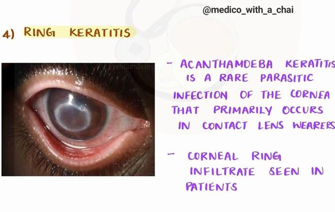 Ring Keratitis