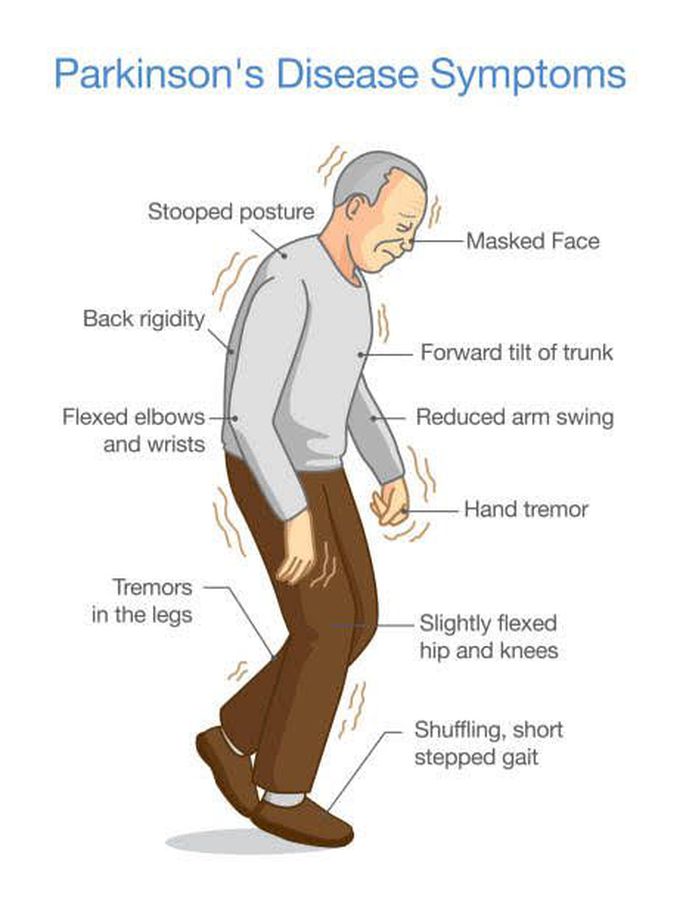 Parkinson s disease medizzy