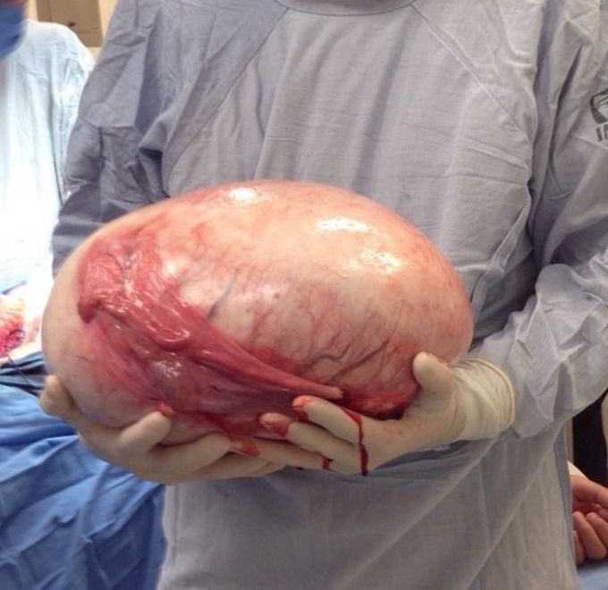Ovarian  tumor
