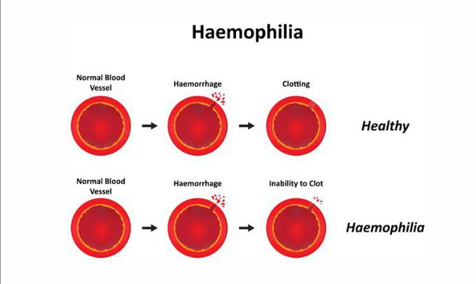 Haemophilia